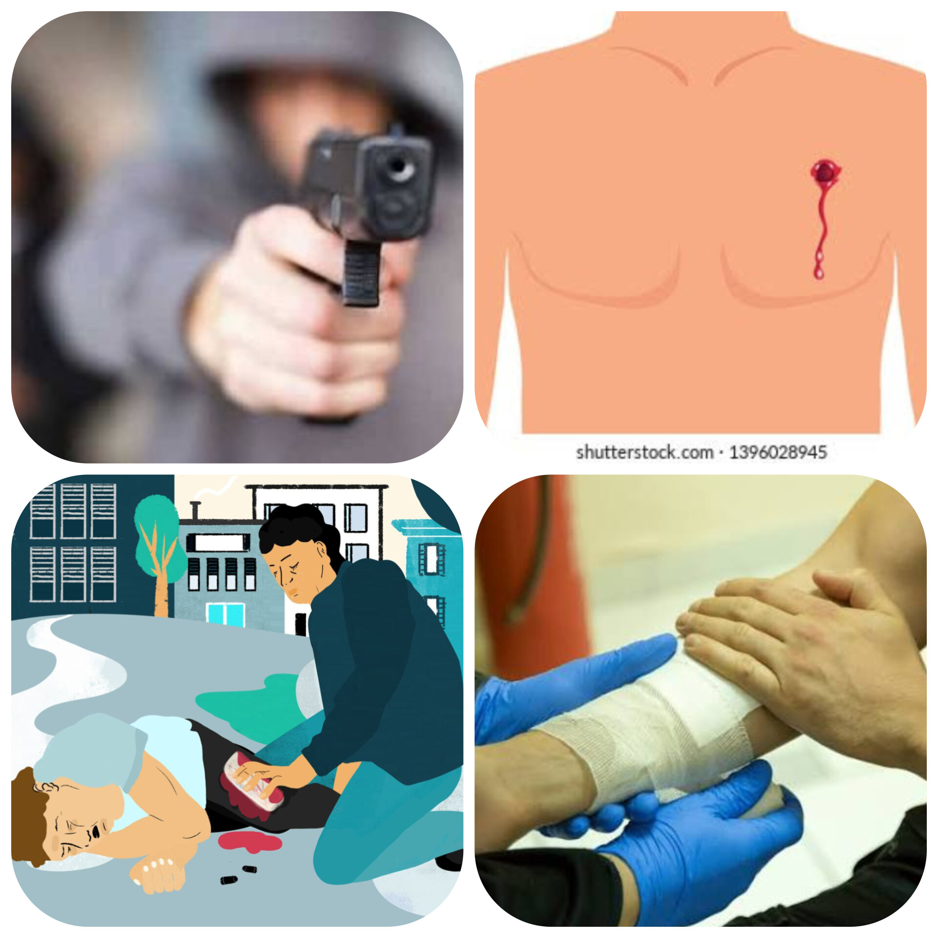 آشنایی عمومی با تیرخوردگی (زخم‌های ناشی از اصابت گلوله)