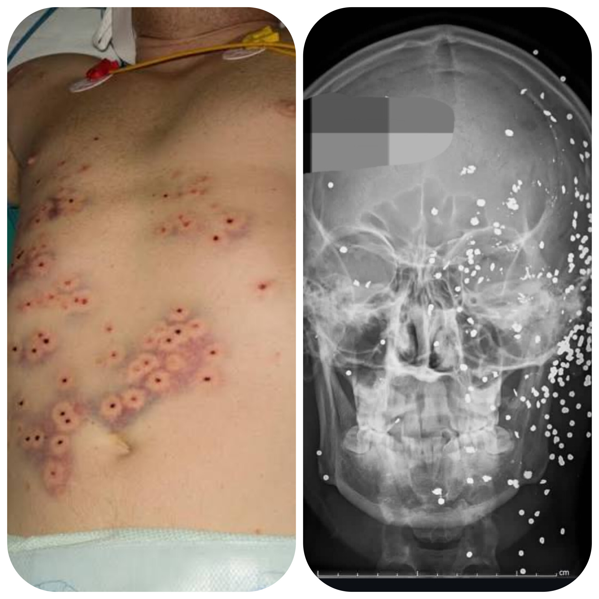 آشنایی عمومی با آسیب‌های ناشی از تفنگ ساچمه‌ای